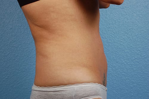 Liposuction Before & After Gallery - Patient 290094 - Image 5