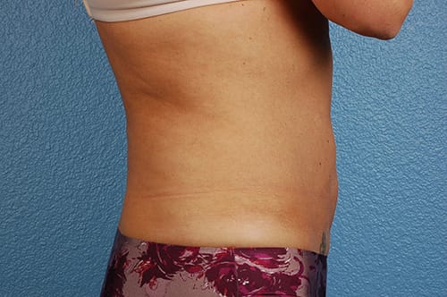 Liposuction Before & After Gallery - Patient 290094 - Image 6