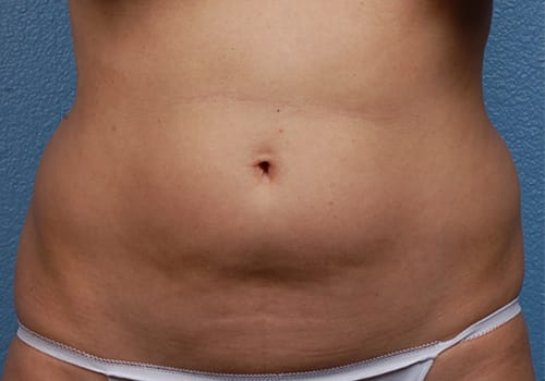 Liposuction Before & After Gallery - Patient 406129 - Image 1