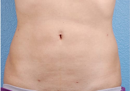 Liposuction Before & After Gallery - Patient 406129 - Image 2