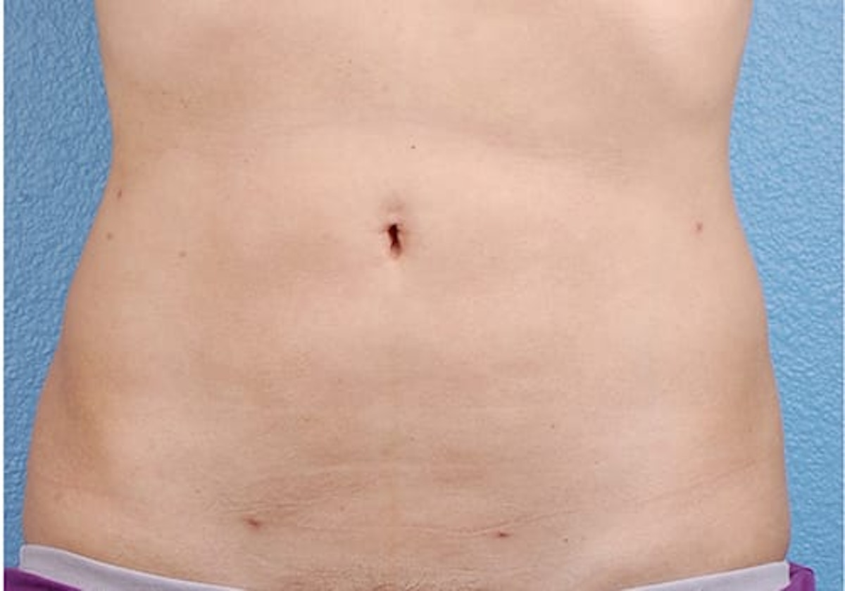 Liposuction Before & After Gallery - Patient 406129 - Image 2