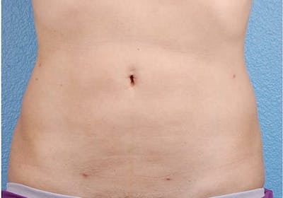 Liposuction Before & After Gallery - Patient 406129 - Image 2