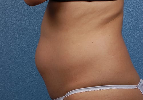 Liposuction Before & After Gallery - Patient 406129 - Image 3