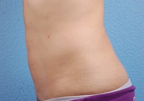 Liposuction Before & After Gallery - Patient 406129 - Image 4