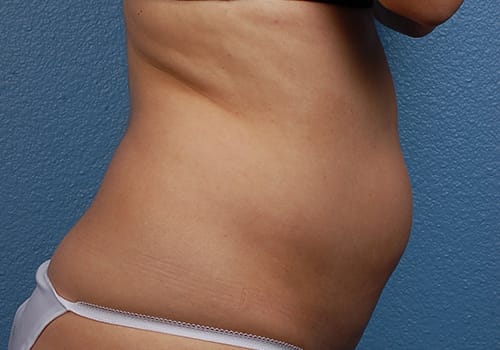 Liposuction Before & After Gallery - Patient 406129 - Image 5