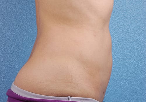 Liposuction Before & After Gallery - Patient 406129 - Image 6
