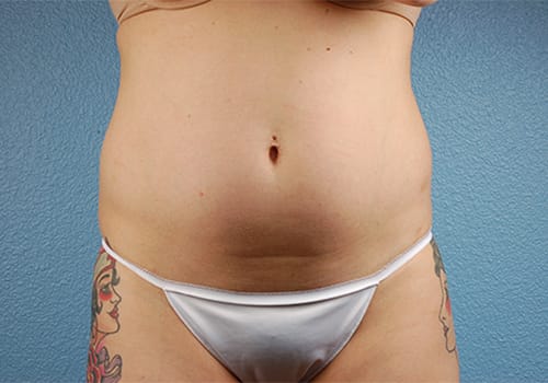 Liposuction Before & After Gallery - Patient 301902 - Image 1