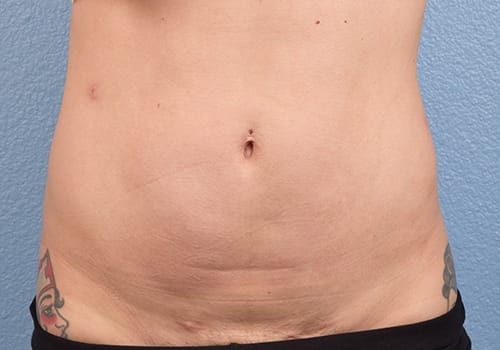 Liposuction Before & After Gallery - Patient 301902 - Image 2