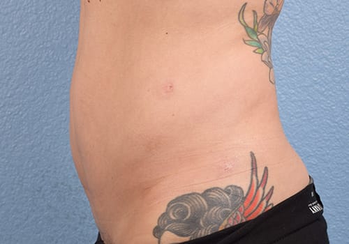 Liposuction Before & After Gallery - Patient 301902 - Image 4