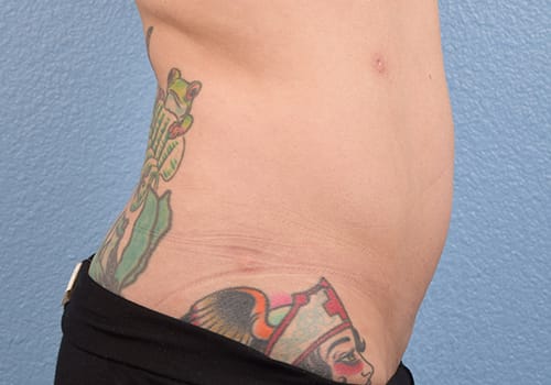 Liposuction Before & After Gallery - Patient 301902 - Image 6