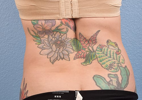 Liposuction Before & After Gallery - Patient 301902 - Image 8