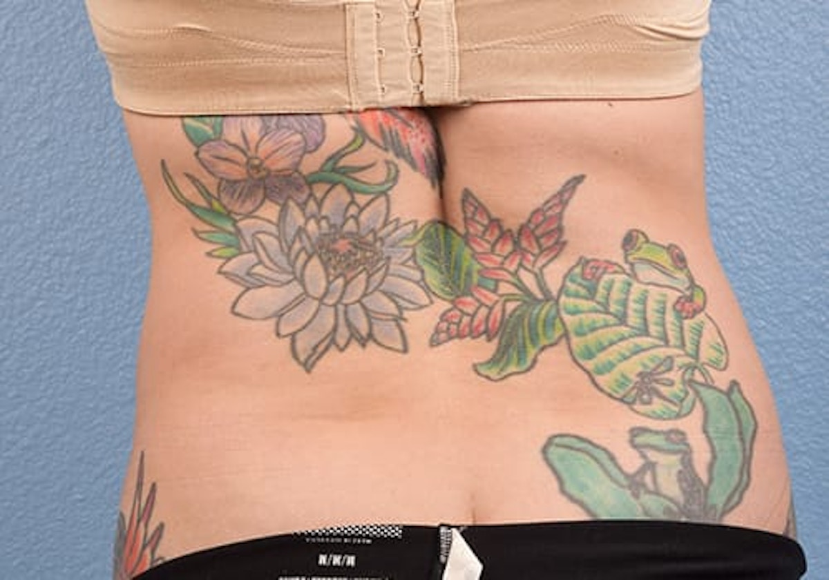 Liposuction Before & After Gallery - Patient 301902 - Image 8