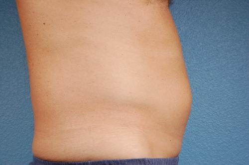 Liposuction Before & After Gallery - Patient 135889 - Image 1