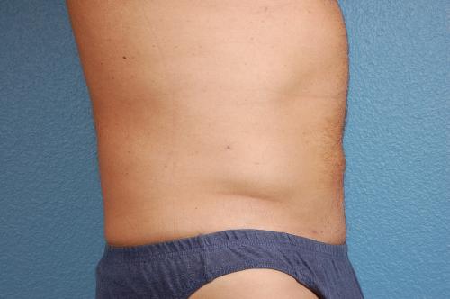 Liposuction Before & After Gallery - Patient 135889 - Image 2