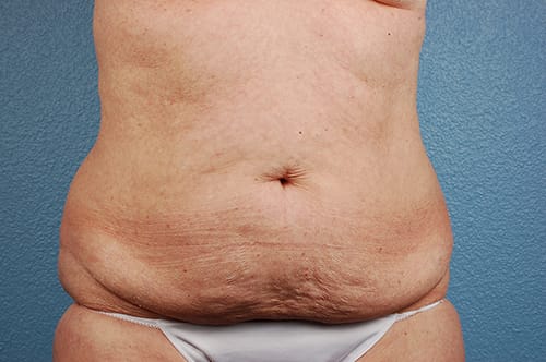 Hidden Patients Before & After Gallery - Patient 107940 - Image 1