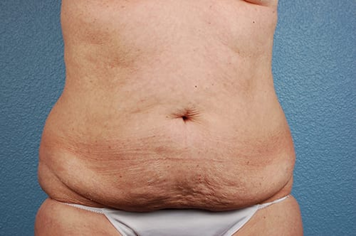Liposuction Before & After Gallery - Patient 152468 - Image 1