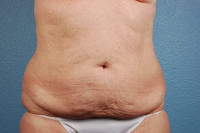Liposuction Before & After Gallery - Patient 152468 - Image 1