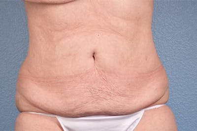 Liposuction Before & After Gallery - Patient 152468 - Image 2
