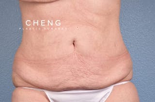 Hidden Patients Before & After Gallery - Patient 107940 - Image 2