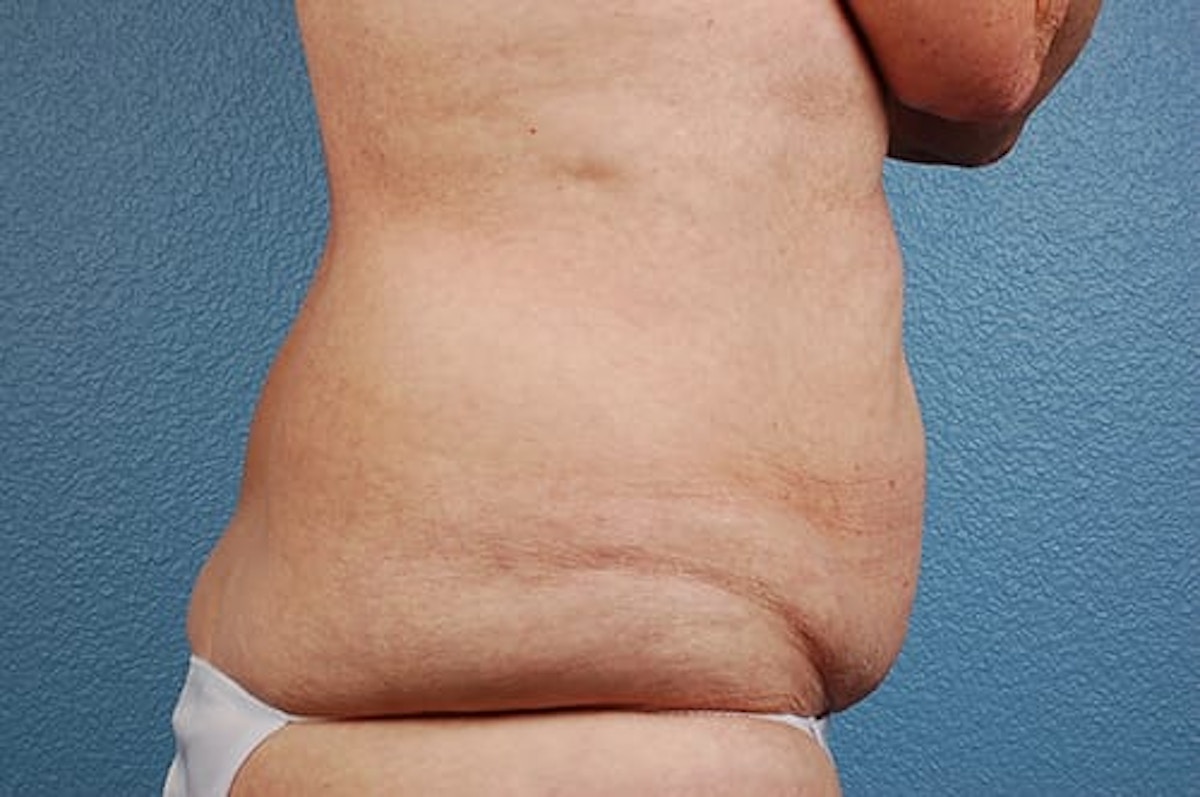 Liposuction Before & After Gallery - Patient 152468 - Image 3