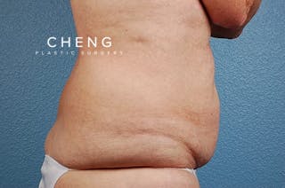 Hidden Patients Before & After Gallery - Patient 107940 - Image 3
