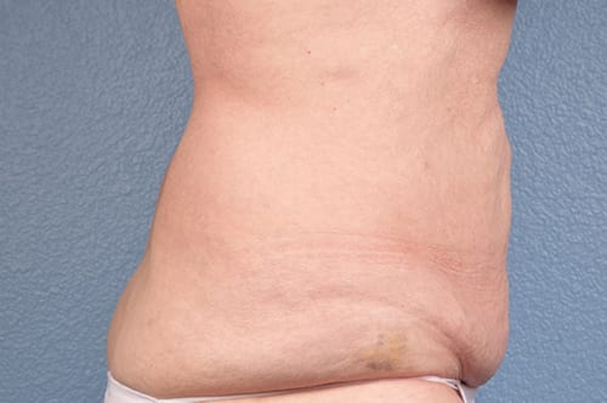 Liposuction Before & After Gallery - Patient 152468 - Image 4
