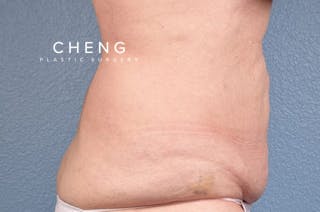 Hidden Patients Before & After Gallery - Patient 107940 - Image 4