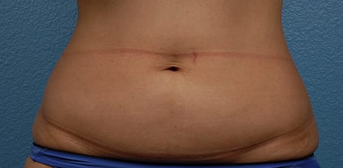 Hidden Patients Before & After Gallery - Patient 331001 - Image 1