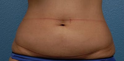 Liposuction Before & After Gallery - Patient 330875 - Image 1