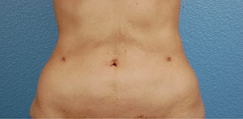 Hidden Patients Before & After Gallery - Patient 331001 - Image 2