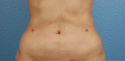 Liposuction Before & After Gallery - Patient 330875 - Image 2