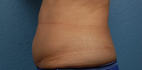 Liposuction Before & After Gallery - Patient 330875 - Image 1