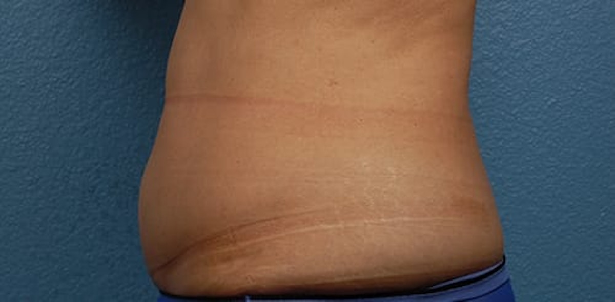 Liposuction Before & After Gallery - Patient 330875 - Image 3