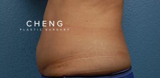 Hidden Patients Before & After Gallery - Patient 331001 - Image 3