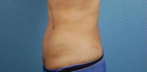 Liposuction Before & After Gallery - Patient 330875 - Image 2