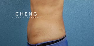 Hidden Patients Before & After Gallery - Patient 331001 - Image 4