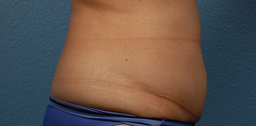 Hidden Patients Before & After Gallery - Patient 331001 - Image 5