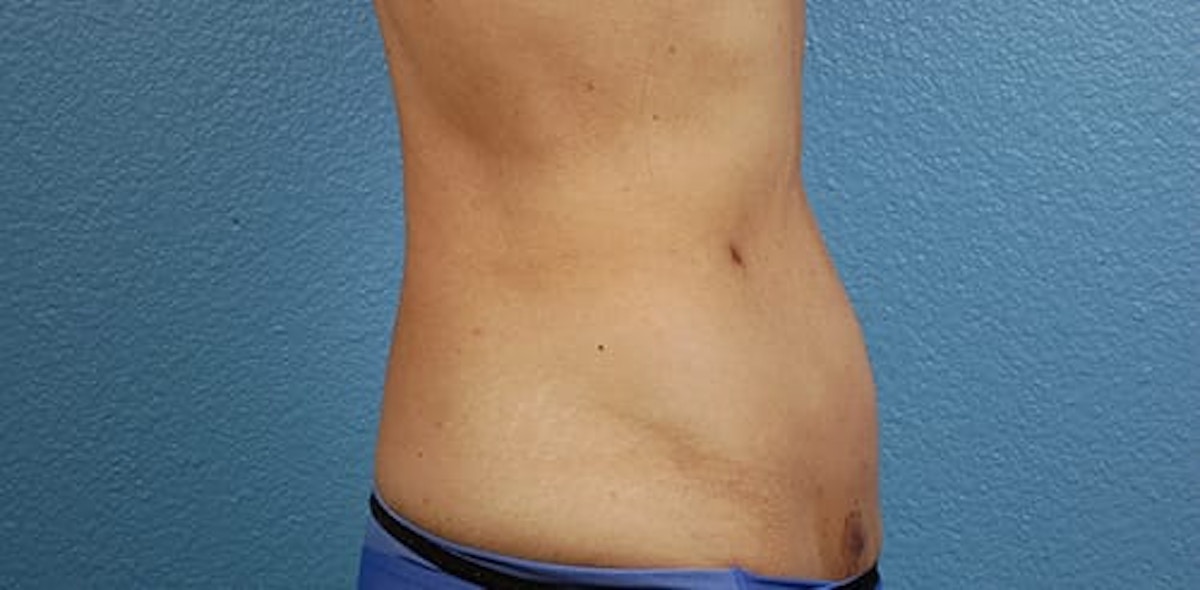 Liposuction Before & After Gallery - Patient 330875 - Image 6