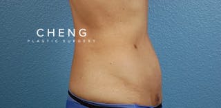 Hidden Patients Before & After Gallery - Patient 331001 - Image 6