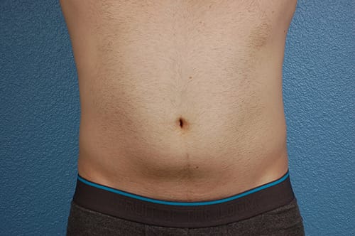 Liposuction Before & After Gallery - Patient 333626 - Image 1