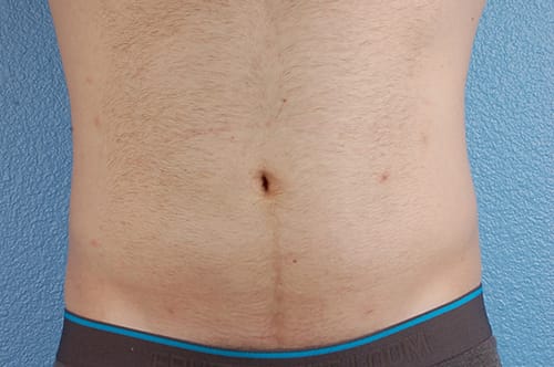 Liposuction Before & After Gallery - Patient 333626 - Image 2