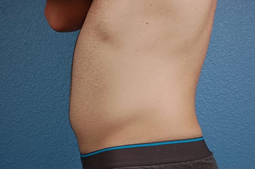 Liposuction Before & After Gallery - Patient 333626 - Image 3