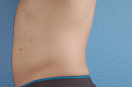 Liposuction Before & After Gallery - Patient 333626 - Image 4