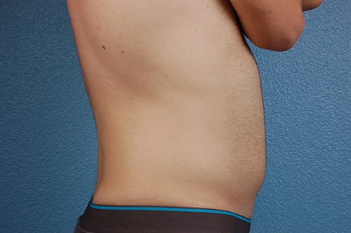 Liposuction Before & After Gallery - Patient 333626 - Image 5