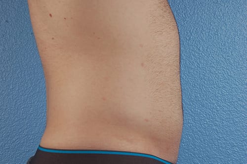 Liposuction Before & After Gallery - Patient 333626 - Image 6