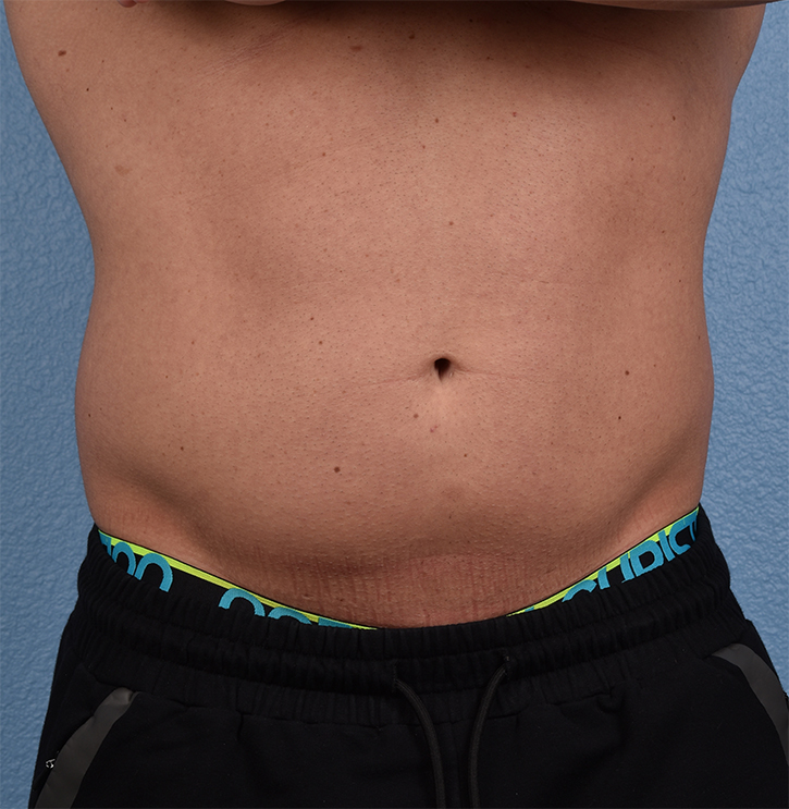Liposuction Before & After Gallery - Patient 267185 - Image 1