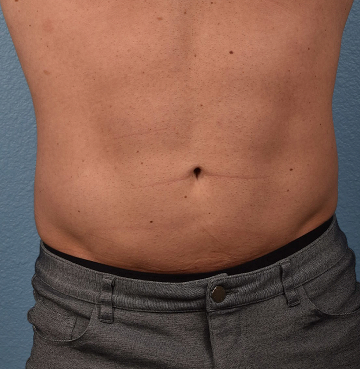 Liposuction Before & After Gallery - Patient 267185 - Image 2