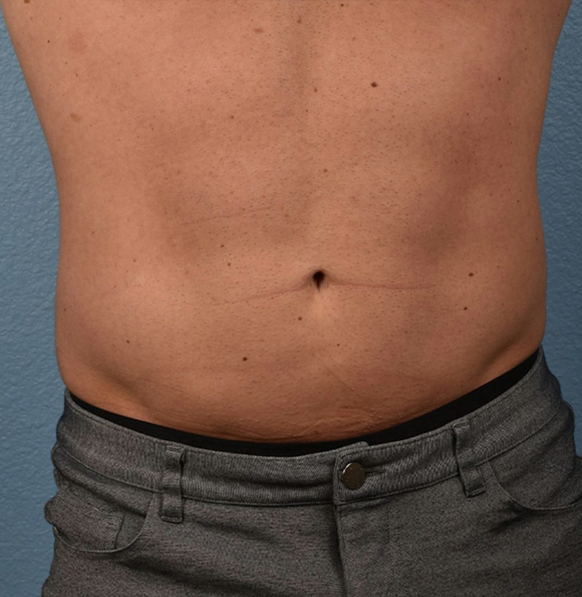 Liposuction Before & After Gallery - Patient 267185 - Image 2