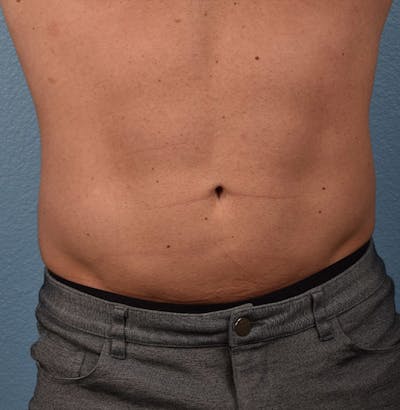 Liposuction Before & After Gallery - Patient 267185 - Image 2