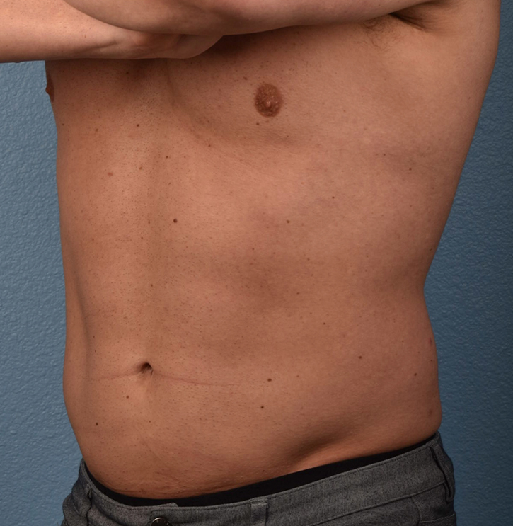 Liposuction Before & After Gallery - Patient 267185 - Image 4
